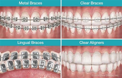 The Cost and Financing Options for Witching Smile Teeth Braces